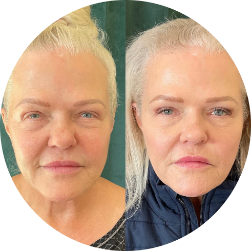 Sculptra before vs after photos at Ageless Health Medicine in Bend Oregon