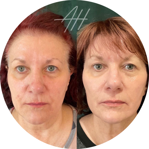 Sculptra Benefits in Bend Oregon