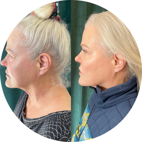 Sculptra in Bend OR